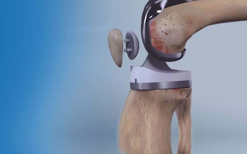 Joint Replacement