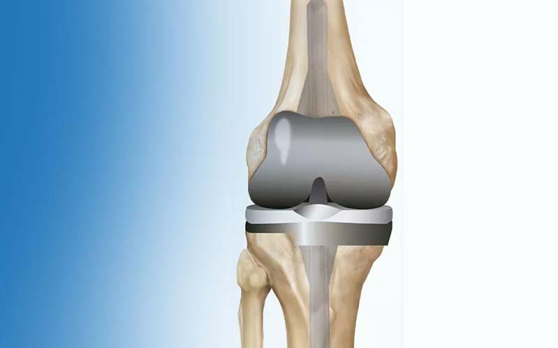 Joint Replacement