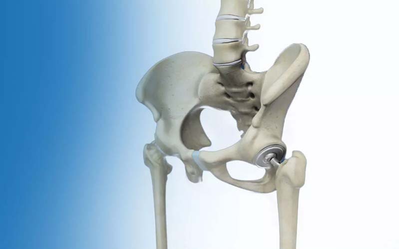 Joint Replacement