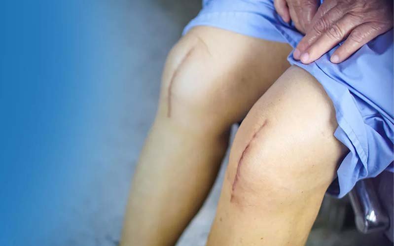 Joint Replacement