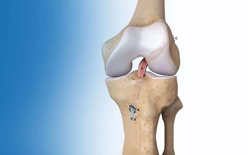 Joint Replacement