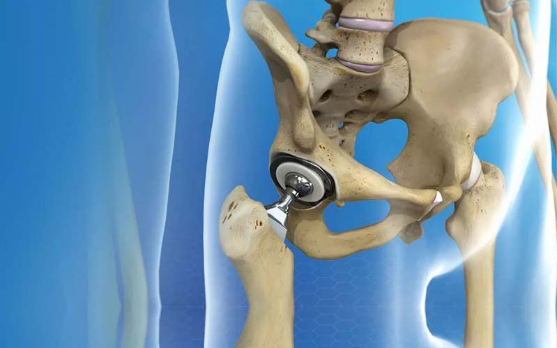 Joint Replacement