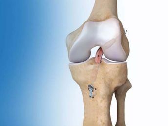 arthroscopic surgery