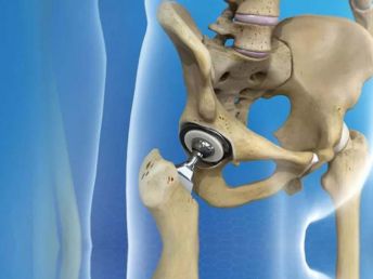 hip replacement surgery greater noida