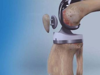 knee replacement surgery greater Noida