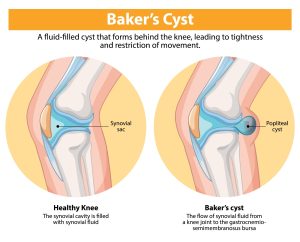 Knee Replacement Lifespan